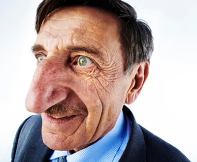 Τουρκία | Ο άνδρας με τη μεγαλύτερη μύτη στον κόσμο