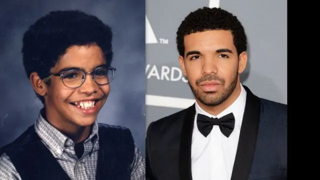 Drake-Before-And-After-Plastic-Surgery-6