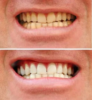 Γιατί κάποιοι έχουν άραγε πιο κίτρινα δόντια από εμάς;