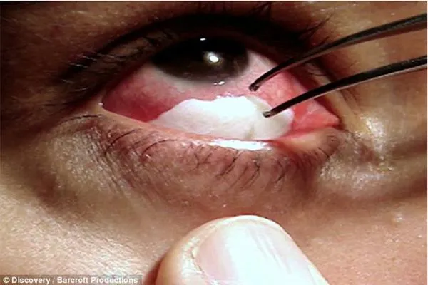 Μια γυναίκα από την Βραζιλία βγάζει κρυστάλλους από τα μάτια της κάθε φορά που κλαίει!