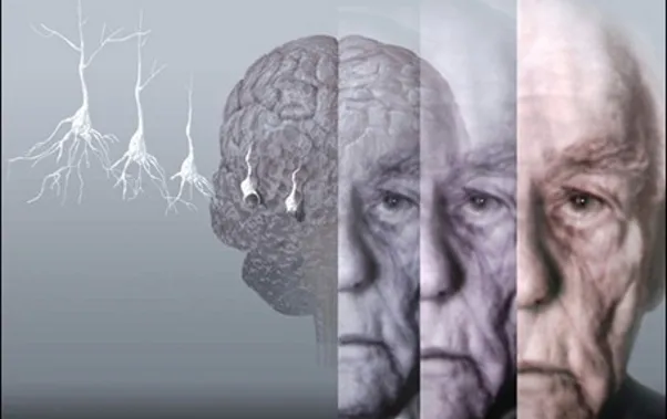Αλτσχάιμερ: Νέα δεδομένα για τα αίτια και τη πρόληψη της νόσου