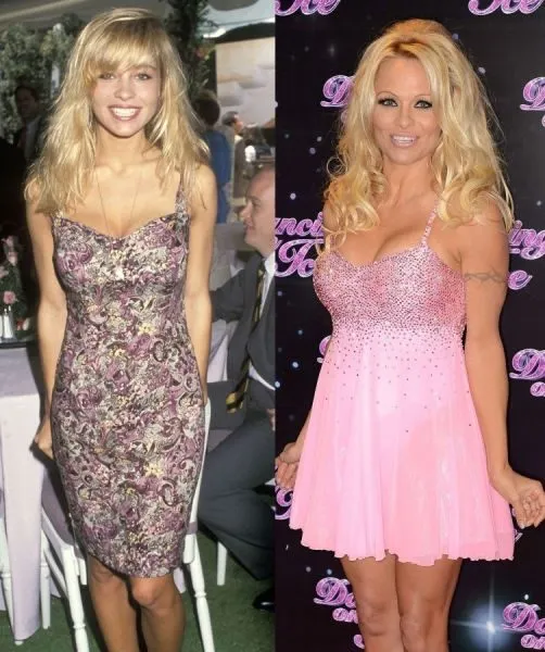 Pamela-Anderson-before-and-after-plastic-surgery-04